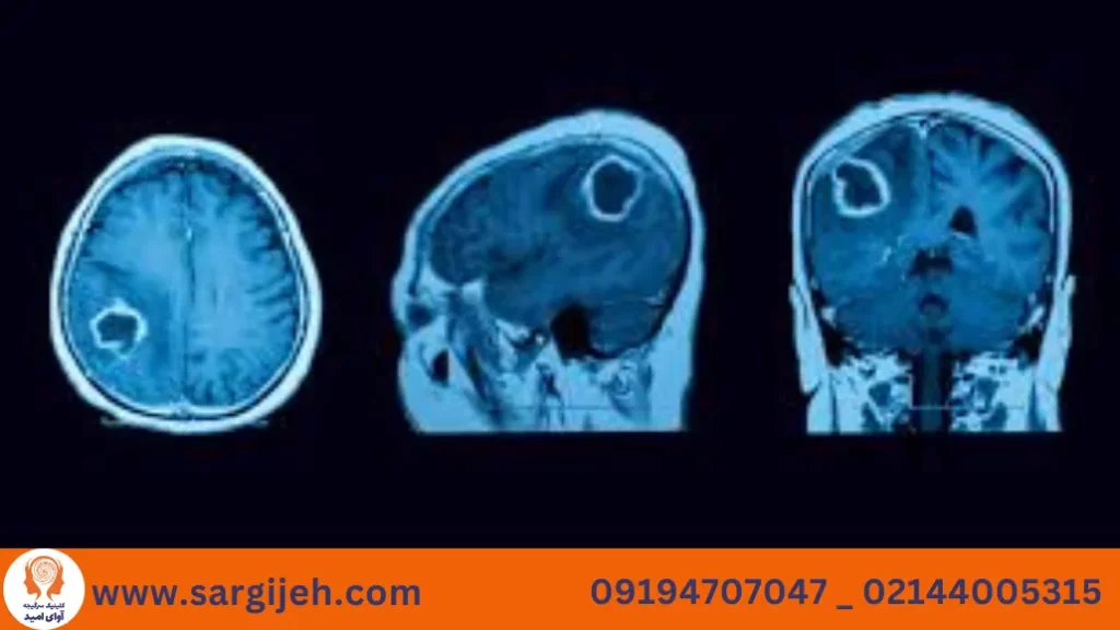 سرگیجه به دلیل تومور مغزی